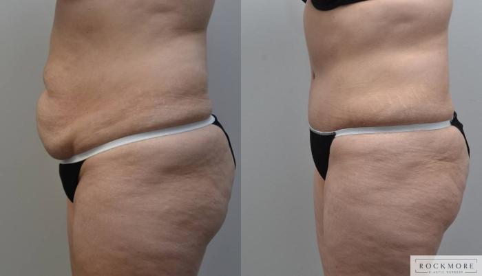 Before & After Tummy Tuck Case 184 View #4 View in Albany & Latham, New York