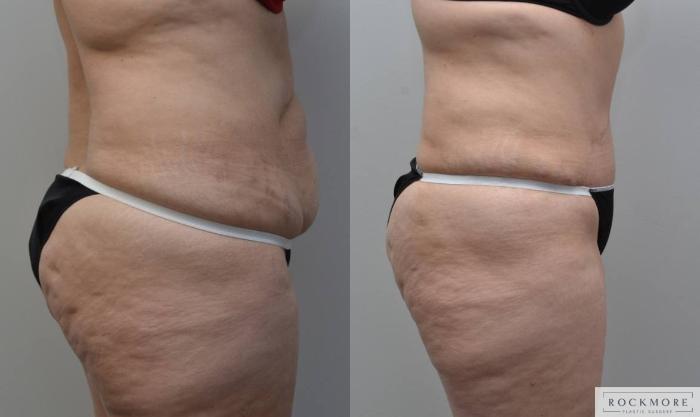 Before & After Tummy Tuck Case 184 View #5 View in Albany & Latham, New York