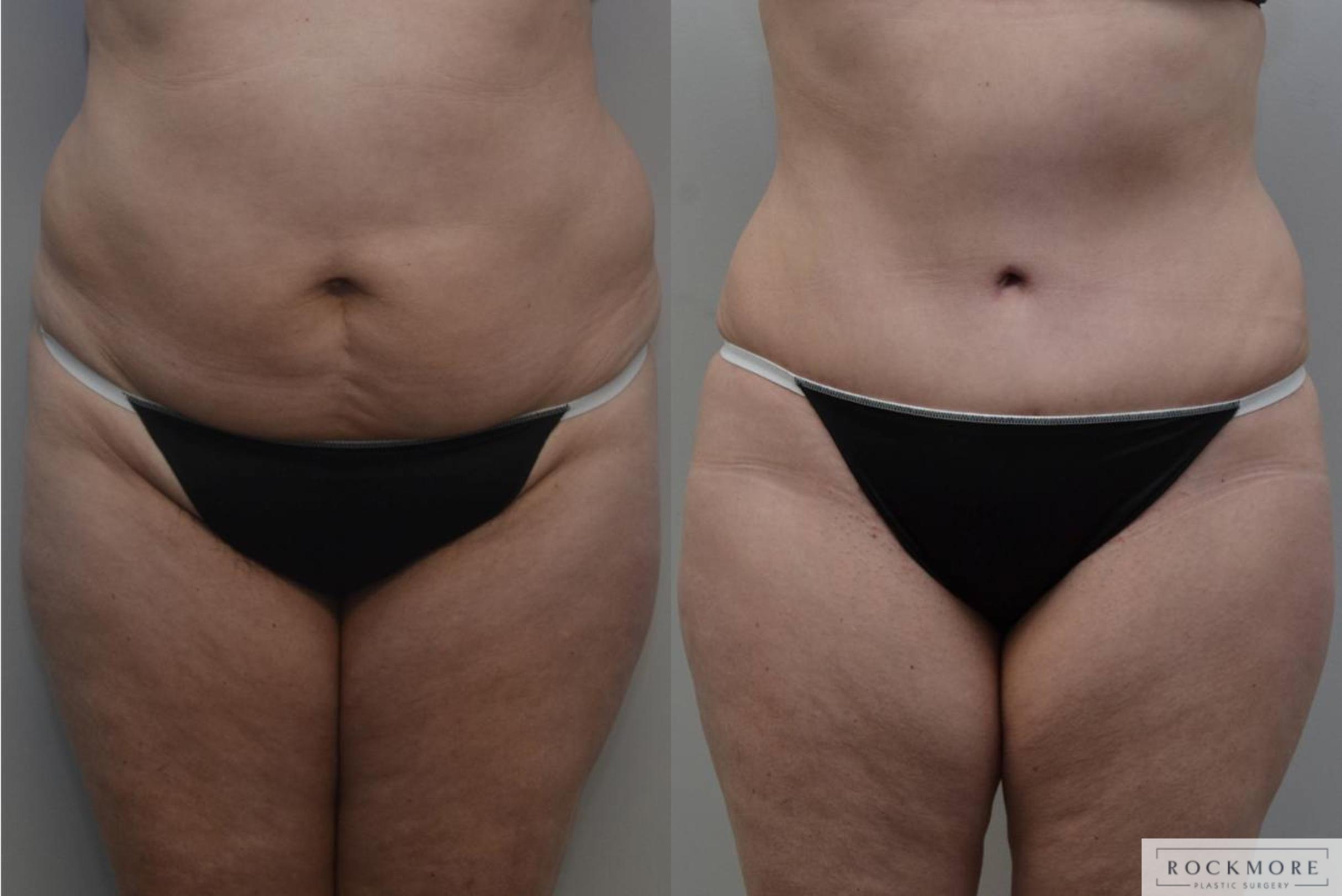 Before & After Tummy Tuck Case 189 View #1 View in Albany & Latham, New York