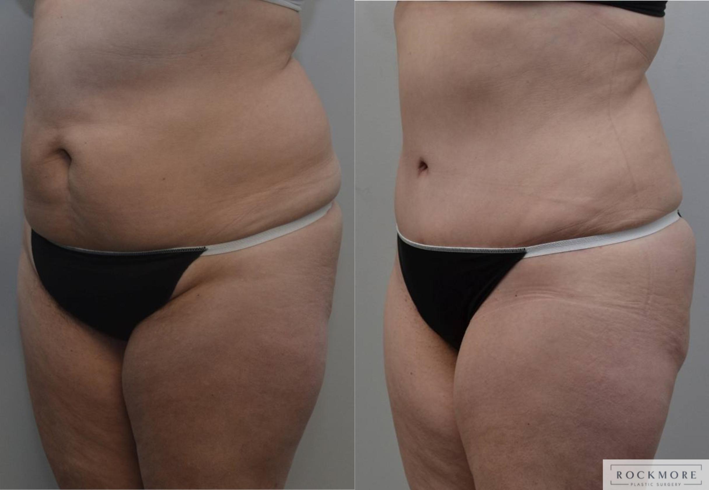 Before & After Tummy Tuck Case 189 View #2 View in Albany & Latham, New York