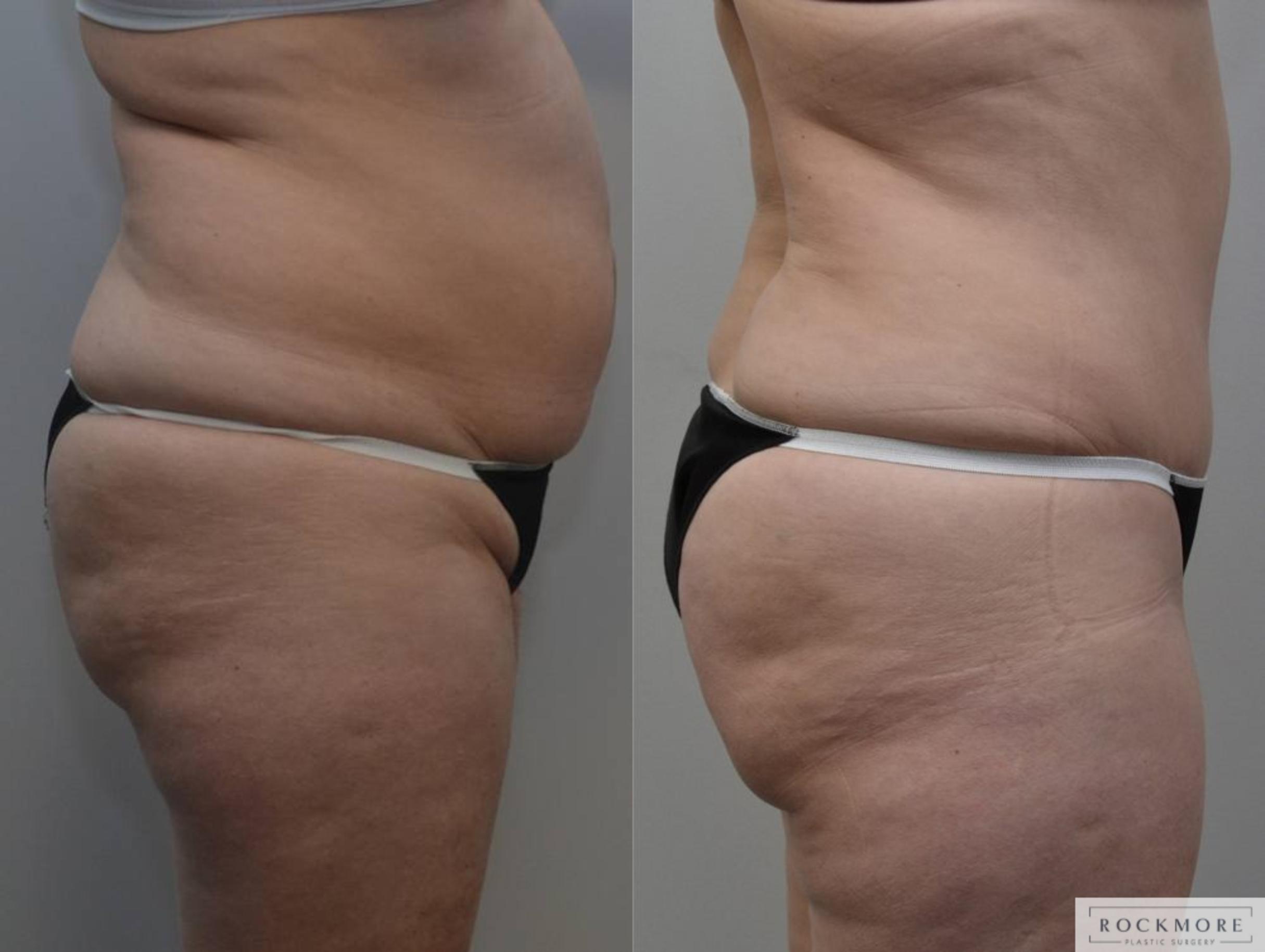Before & After Tummy Tuck Case 189 View #4 View in Albany & Latham, New York