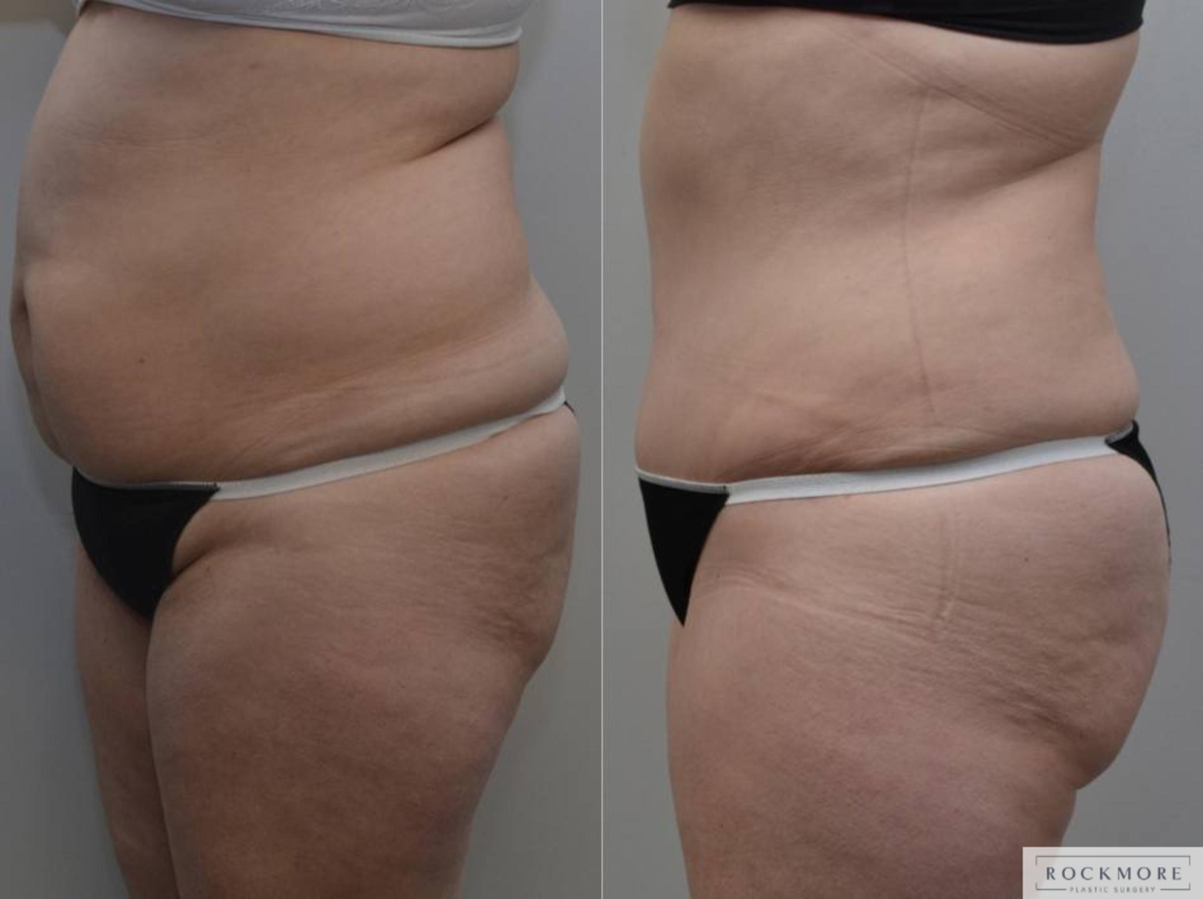 Before & After Tummy Tuck Case 189 View #5 View in Albany & Latham, New York