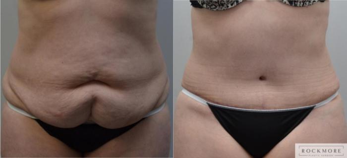 Before & After Tummy Tuck Case 197 View #1 View in Albany & Latham, New York