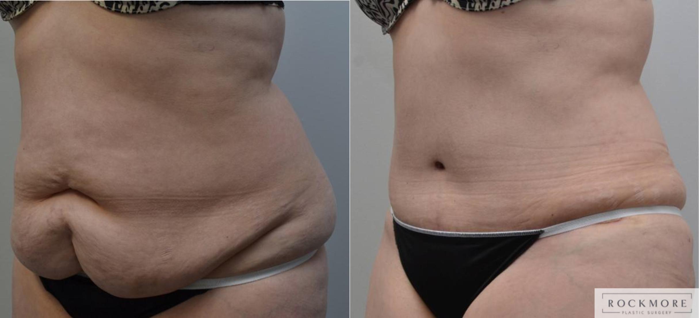 Before & After Tummy Tuck Case 197 View #2 View in Albany & Latham, New York