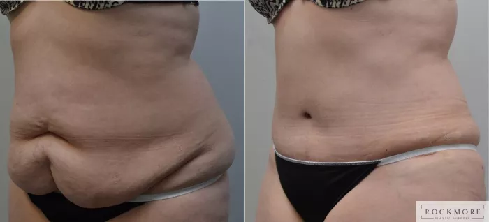 Tummy Tuck Before and After Pictures Case 189, Albany & Latham, New York