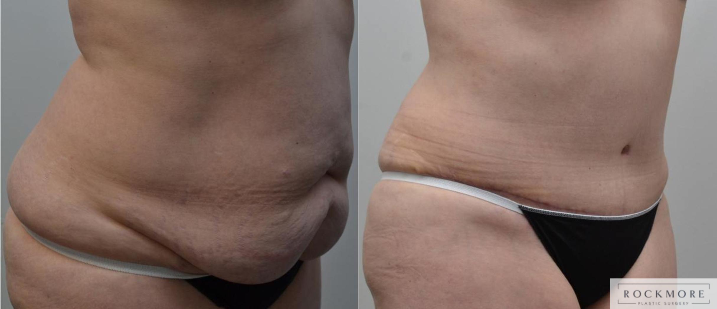 Before & After Tummy Tuck Case 197 View #3 View in Albany & Latham, New York