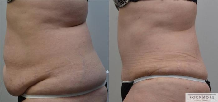 Before & After Tummy Tuck Case 197 View #4 View in Albany & Latham, New York