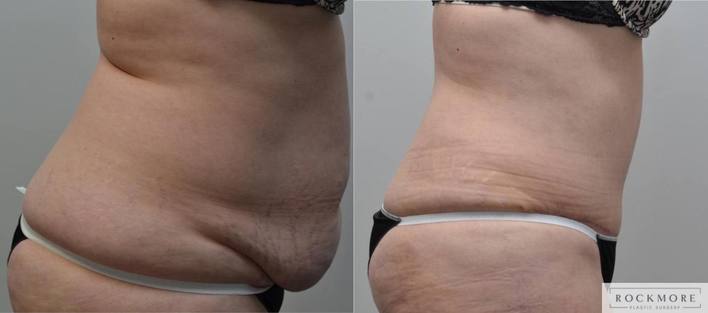 Before & After Tummy Tuck Case 197 View #5 View in Albany & Latham, New York