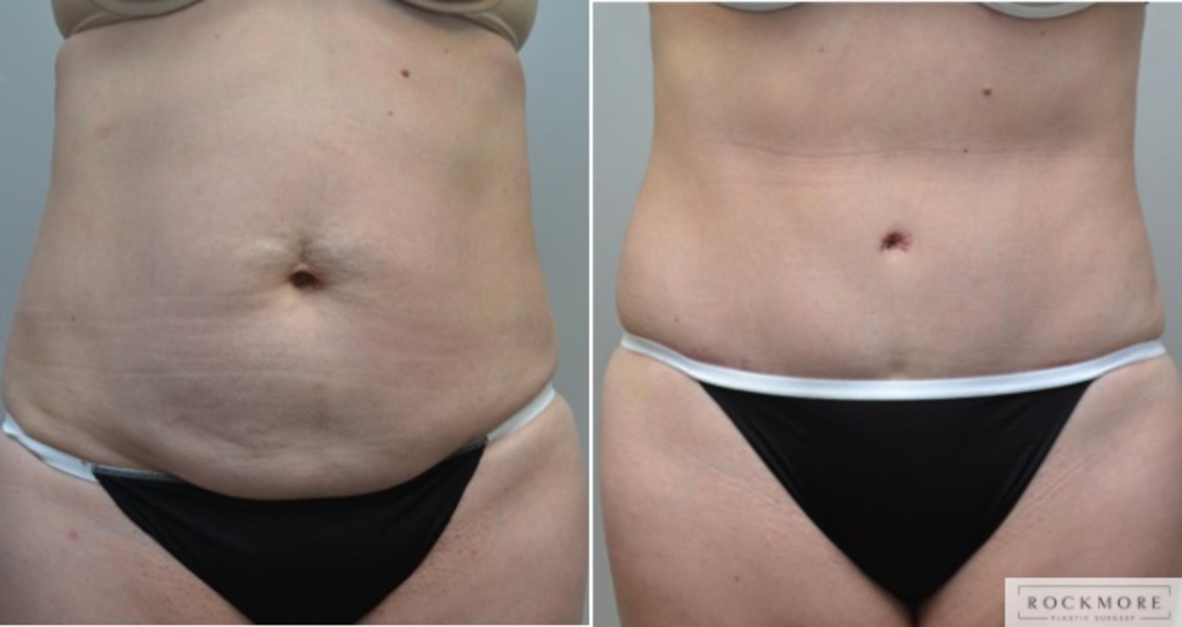 Before & After Tummy Tuck Case 212 View #1 View in Albany & Latham, New York