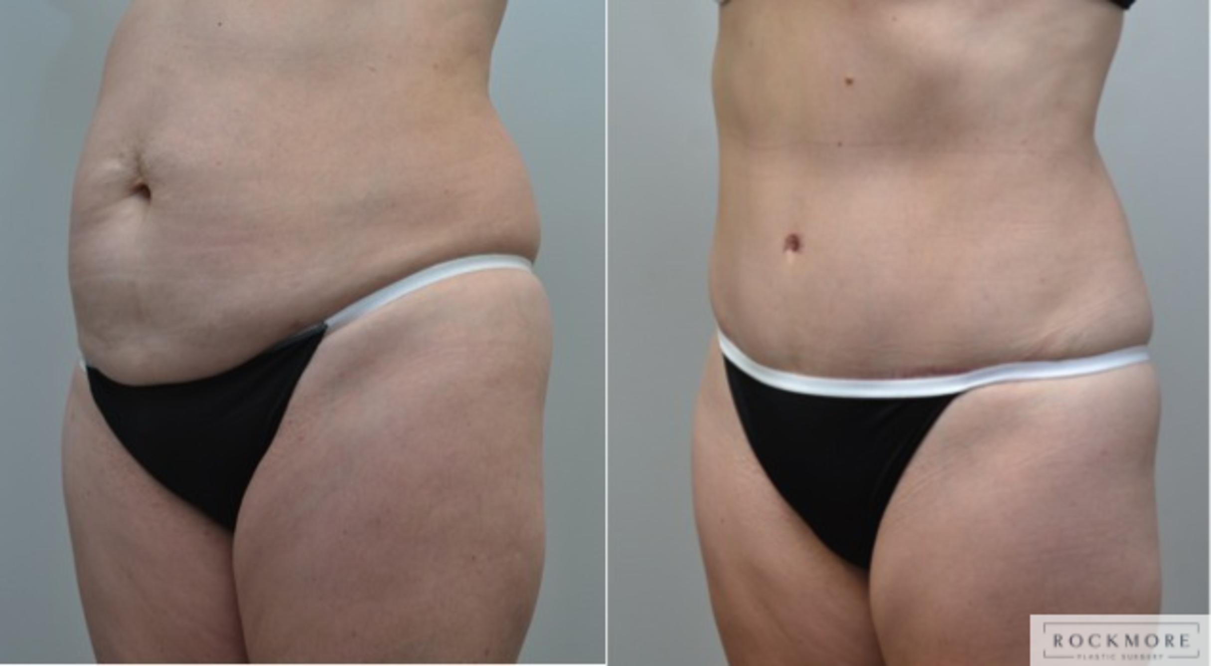 Before & After Tummy Tuck Case 212 View #2 View in Albany & Latham, New York