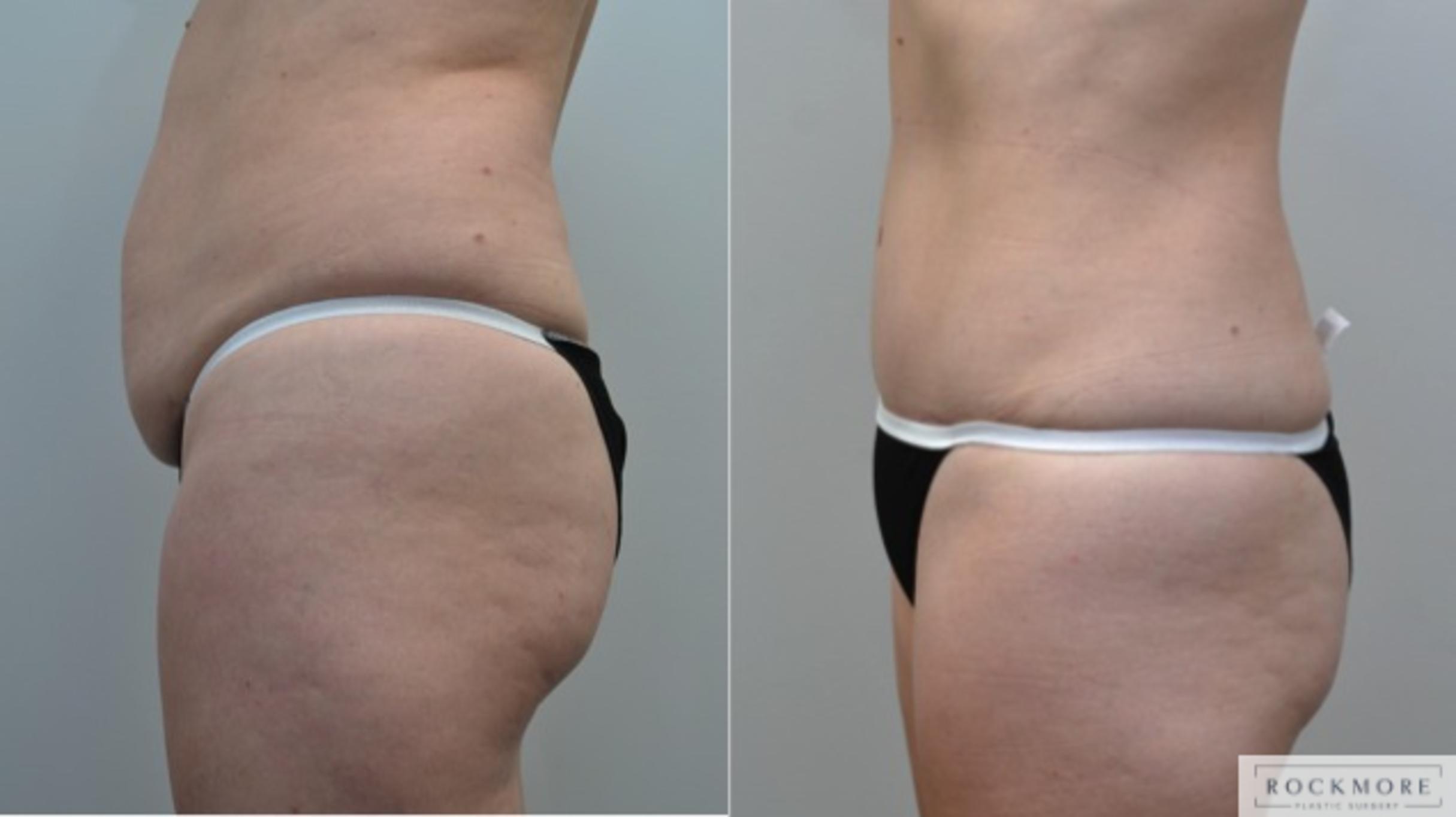 Before & After Tummy Tuck Case 212 View #3 View in Albany & Latham, New York