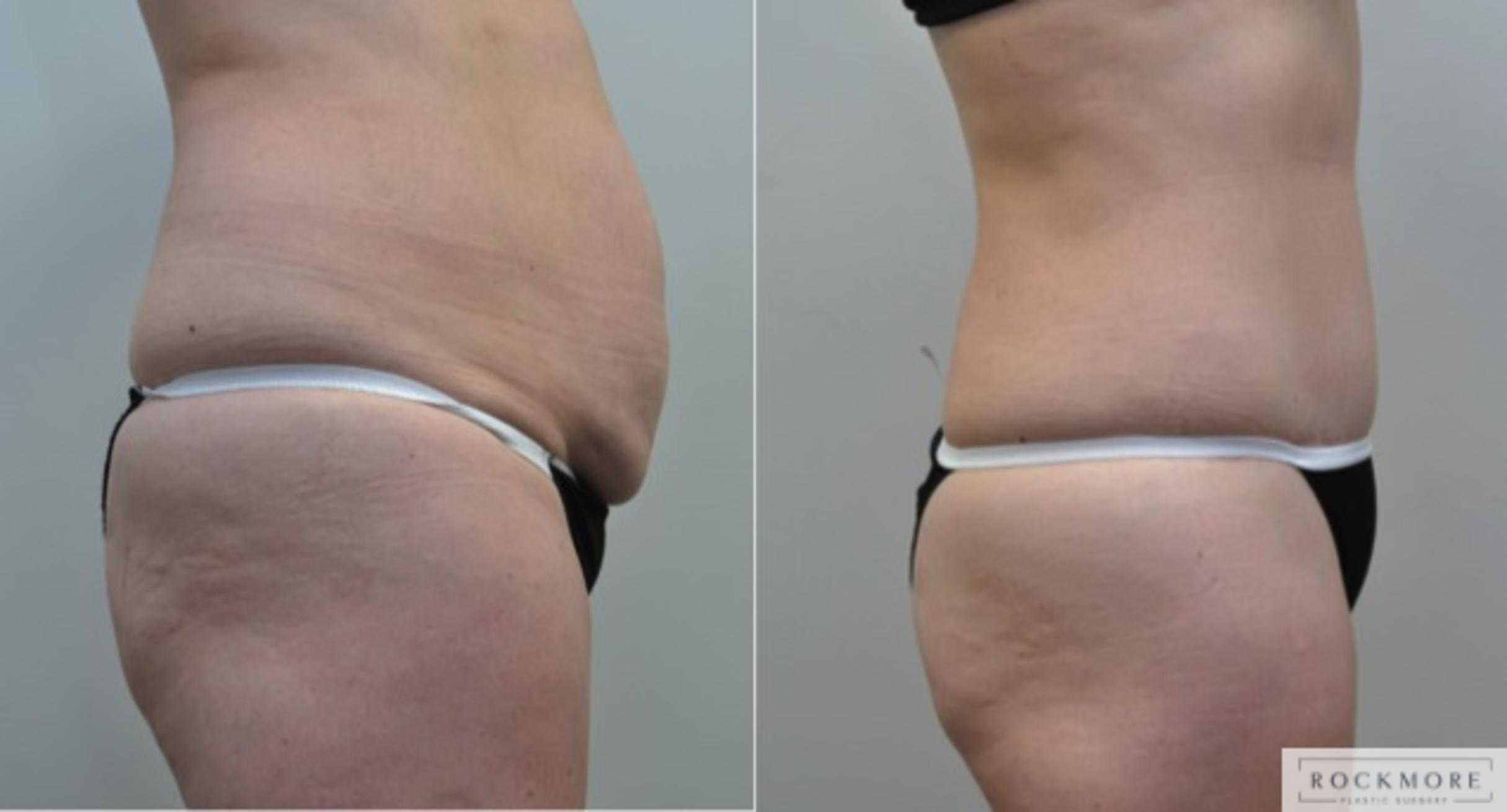 Before & After Tummy Tuck Case 212 View #4 View in Albany & Latham, New York