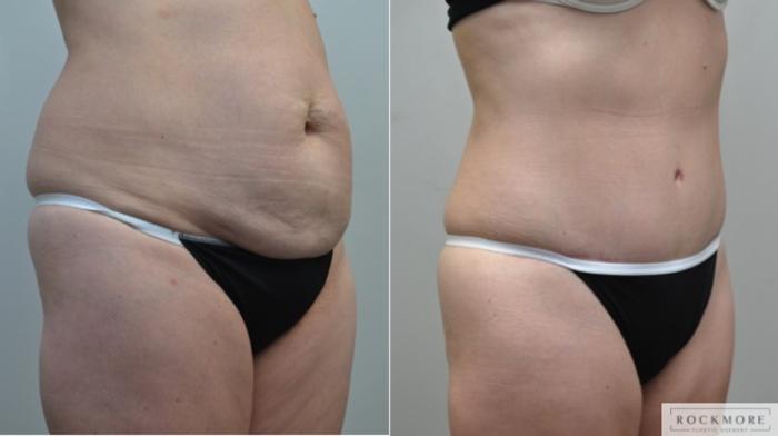 Before & After Tummy Tuck Case 212 View #5 View in Albany & Latham, New York