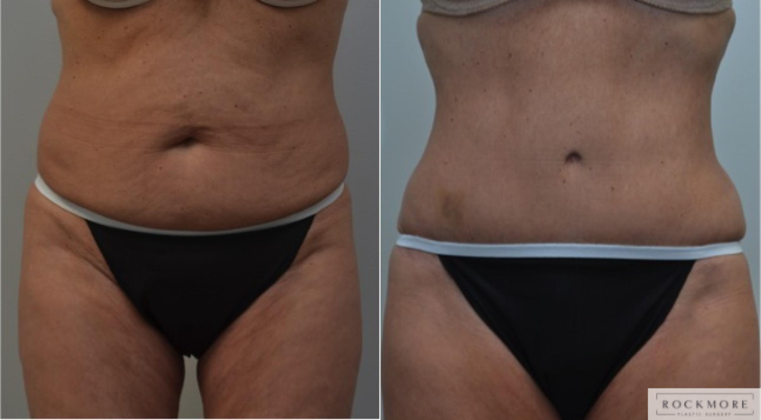 Before & After Tummy Tuck Case 225 View #1 View in Albany & Latham, New York