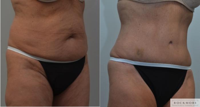 Before & After Tummy Tuck Case 225 View #2 View in Albany & Latham, New York