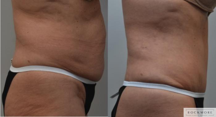 Before & After Tummy Tuck Case 225 View #3 View in Albany & Latham, New York