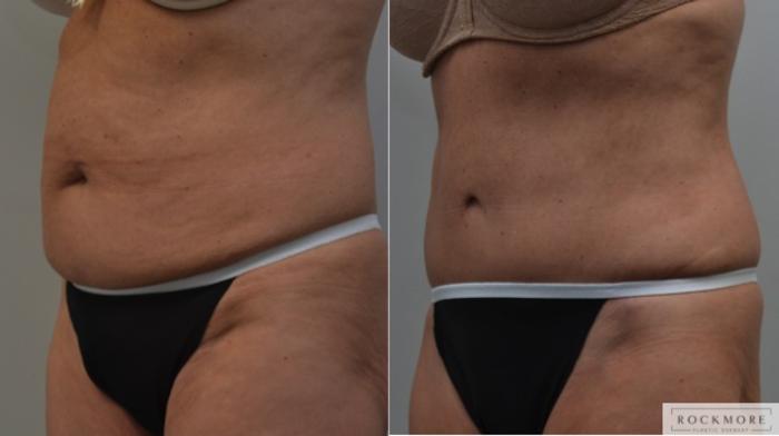 Before & After Tummy Tuck Case 225 View #4 View in Albany & Latham, New York