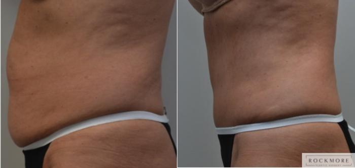 Before & After Tummy Tuck Case 225 View #5 View in Albany & Latham, New York