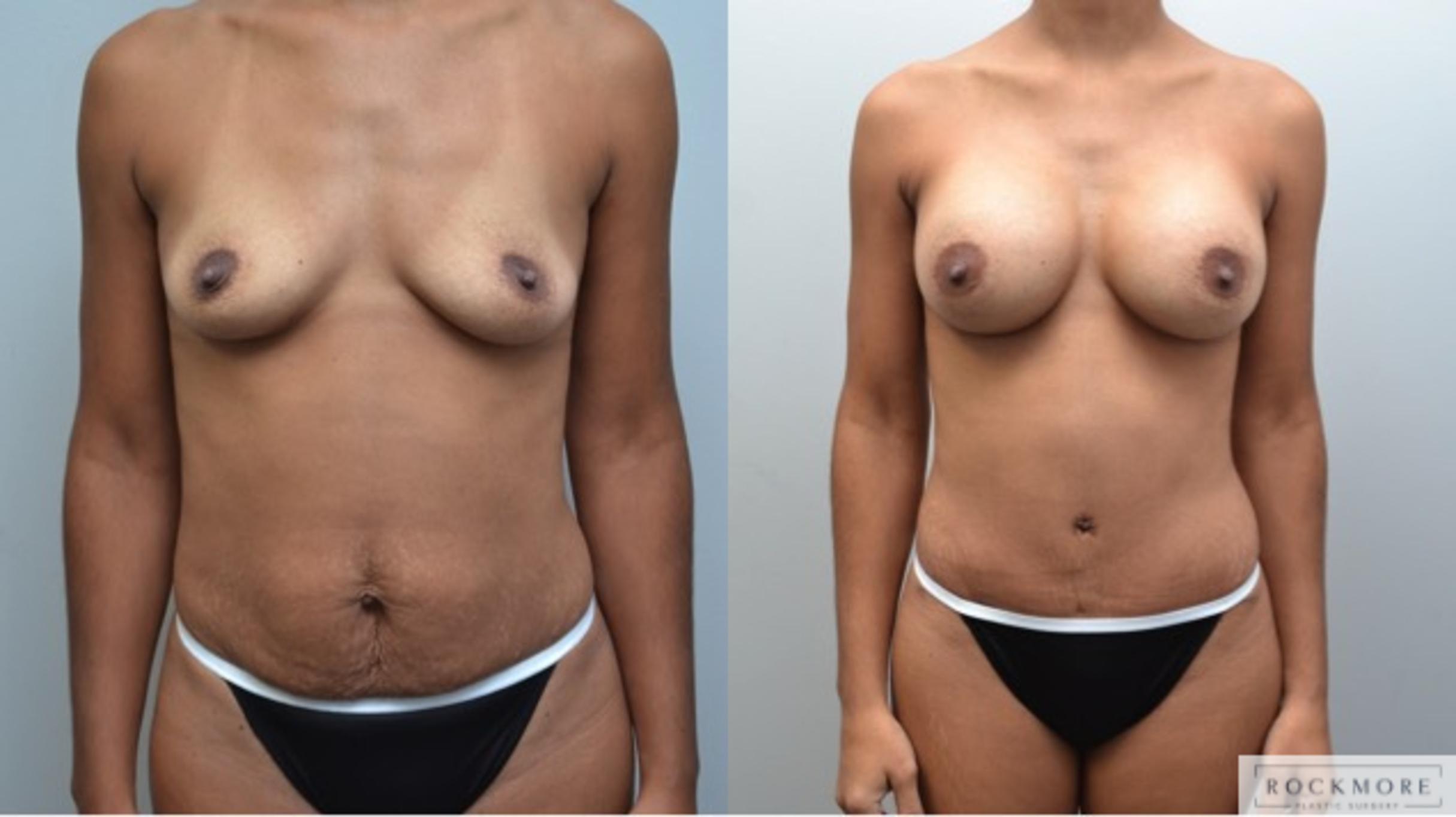 Before & After Tummy Tuck Case 245 View #1 View in Albany & Latham, New York