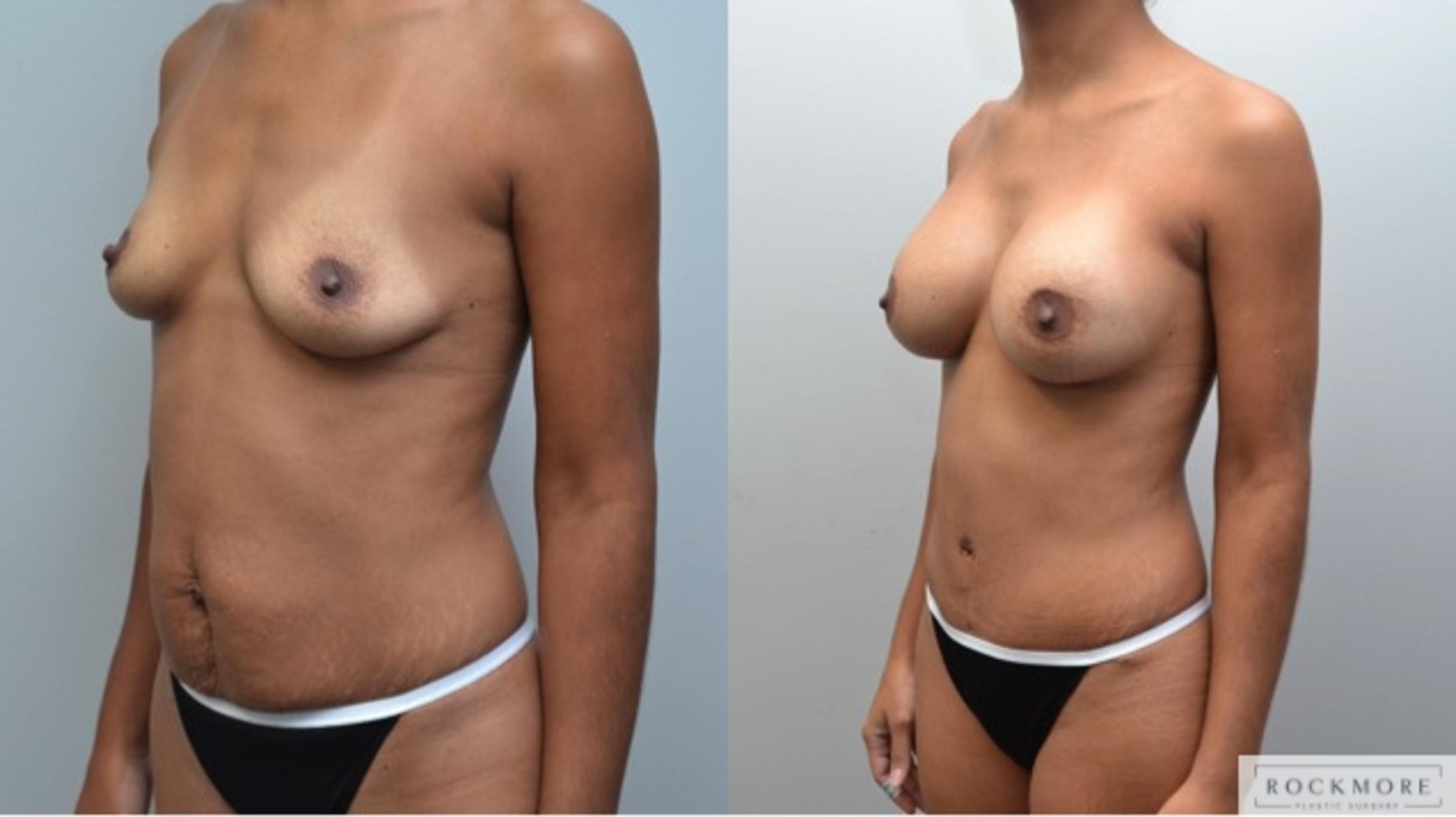 Before & After Tummy Tuck Case 245 View #2 View in Albany & Latham, New York