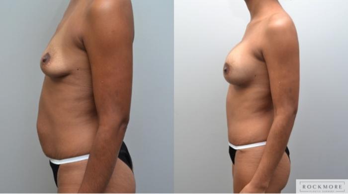 Before & After Tummy Tuck Case 245 View #3 View in Albany & Latham, New York