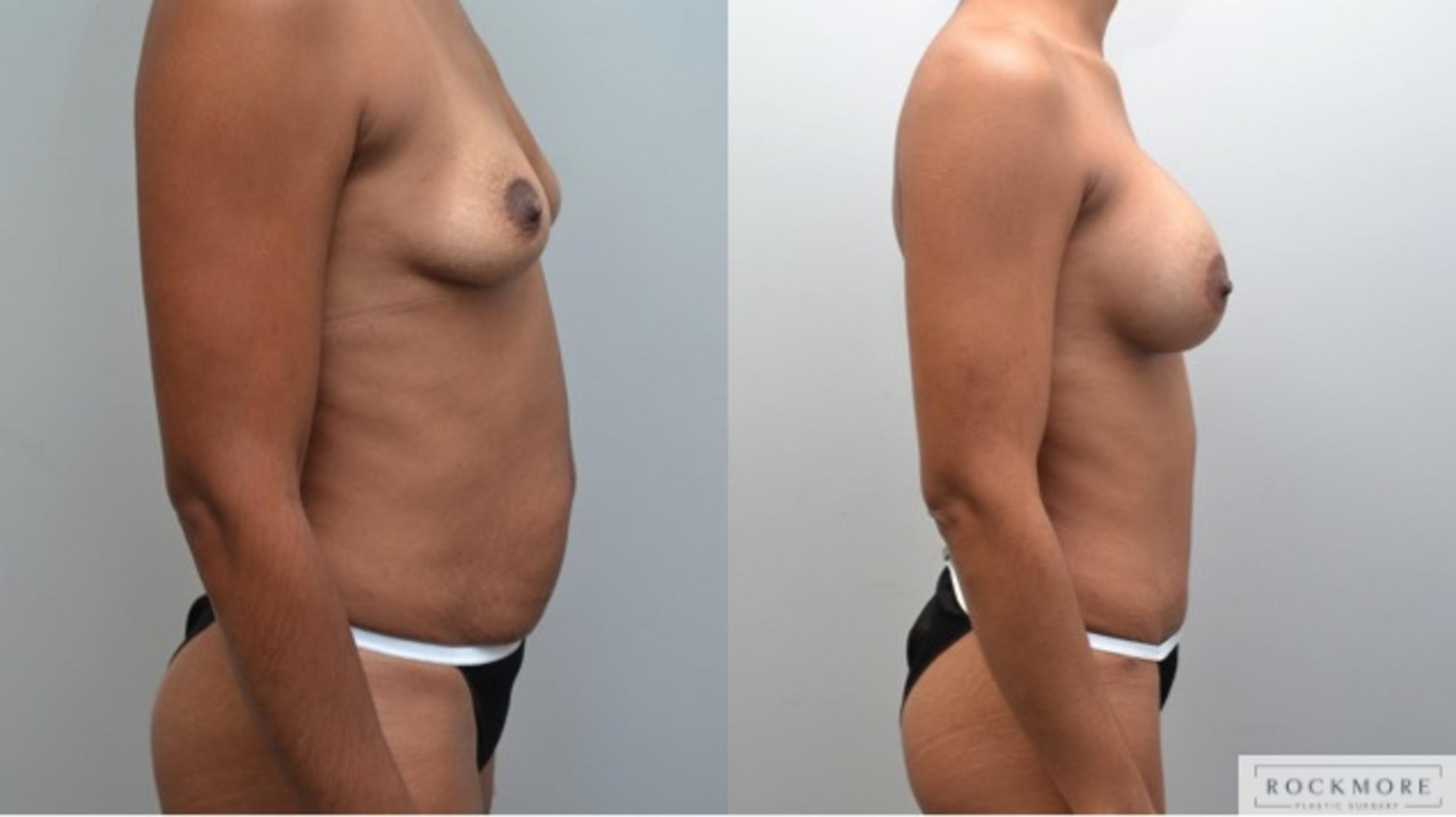 Before & After Tummy Tuck Case 245 View #4 View in Albany & Latham, New York