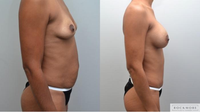 Before & After Tummy Tuck Case 245 View #4 View in Albany & Latham, New York
