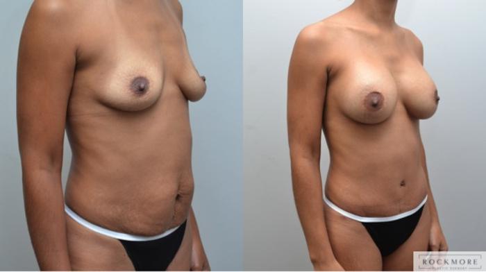 Before & After Tummy Tuck Case 245 View #5 View in Albany & Latham, New York