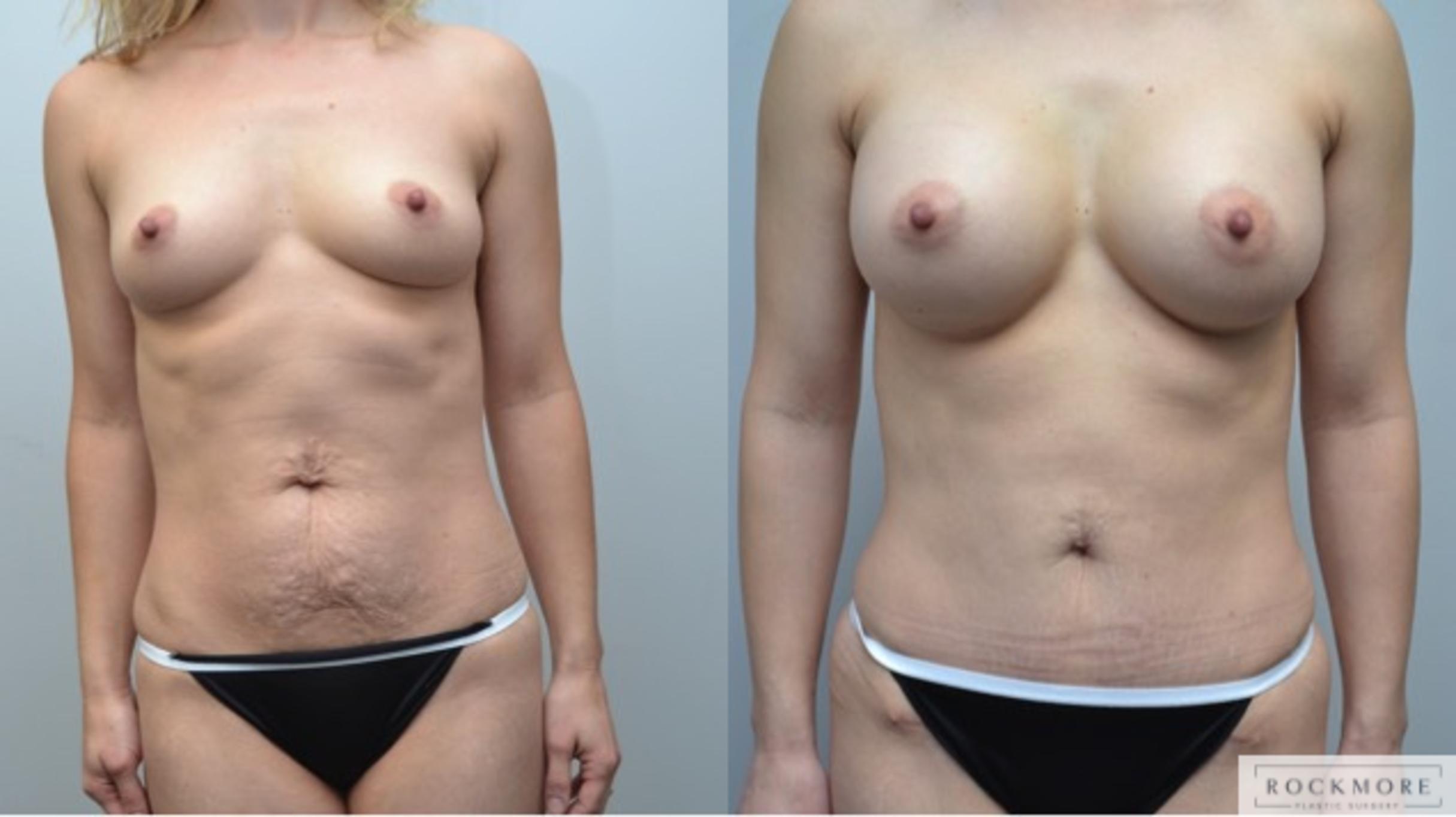 Before & After Tummy Tuck Case 246 View #1 View in Albany & Latham, New York