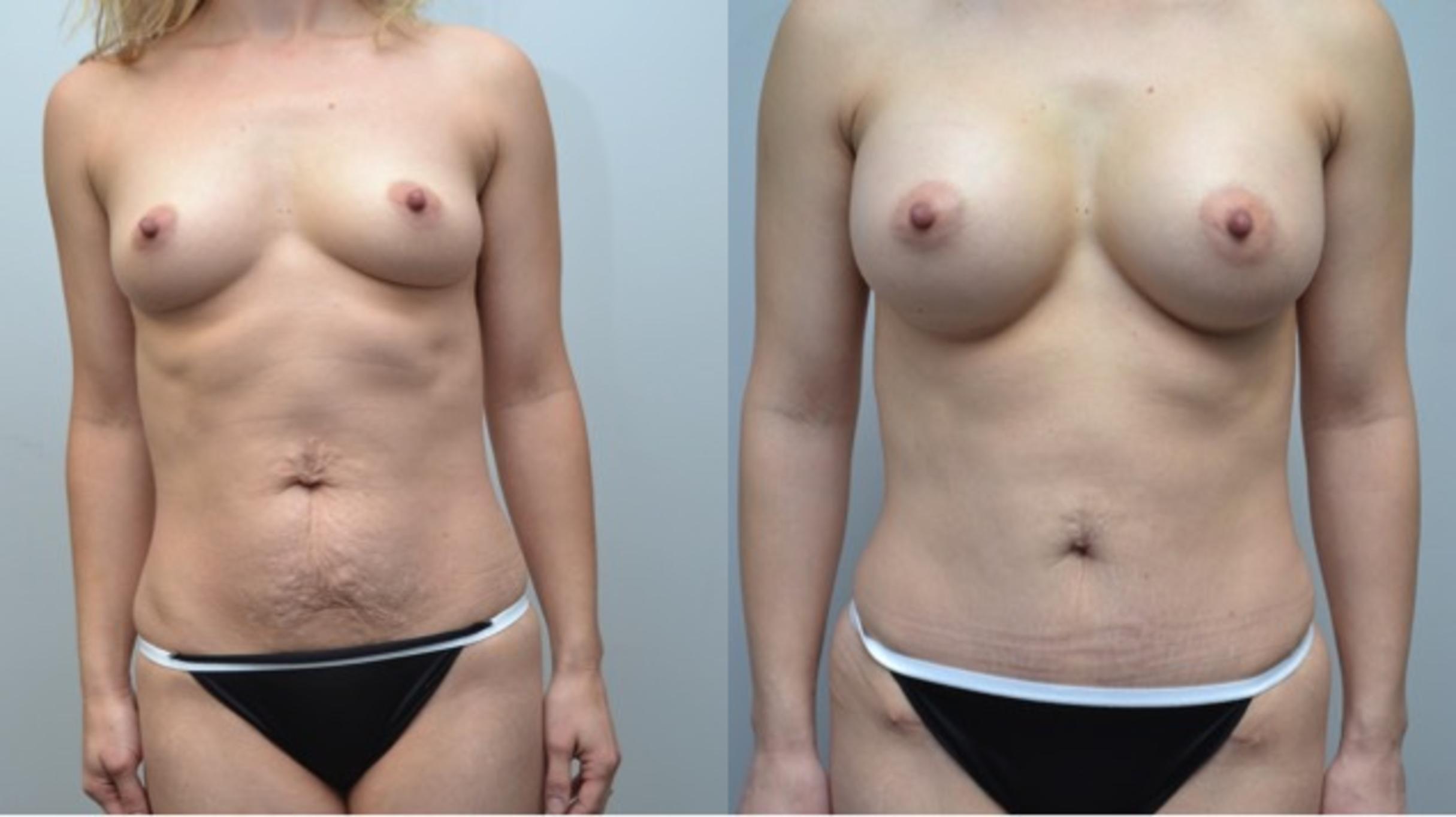 Before & After Tummy Tuck Case 246 View #1 View in Albany & Latham, New York