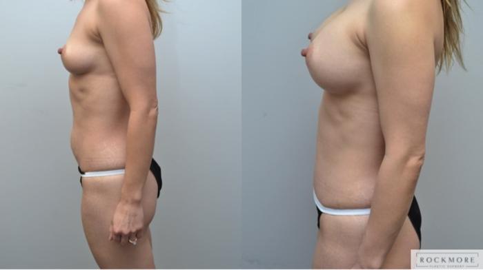 Before & After Tummy Tuck Case 246 View #2 View in Albany & Latham, New York