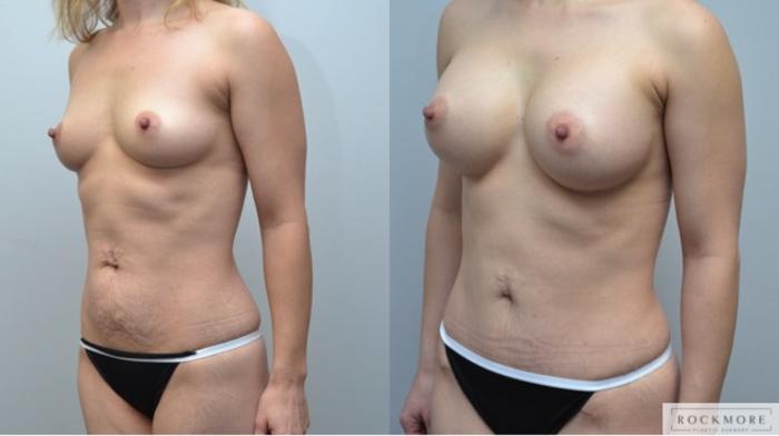 Before & After Tummy Tuck Case 246 View #3 View in Albany & Latham, New York
