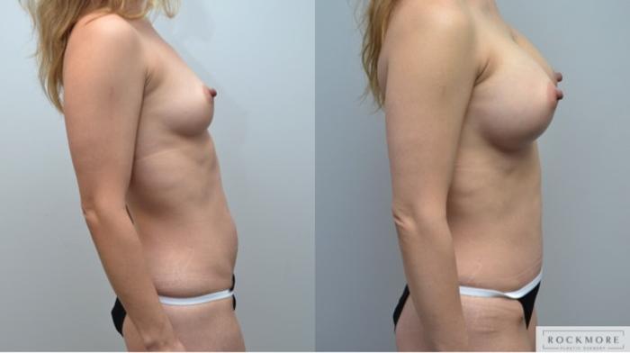 Before & After Tummy Tuck Case 246 View #4 View in Albany & Latham, New York