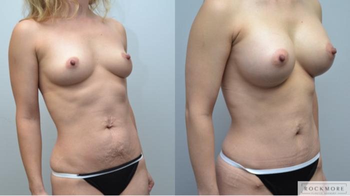 Before & After Tummy Tuck Case 246 View #5 View in Albany & Latham, New York