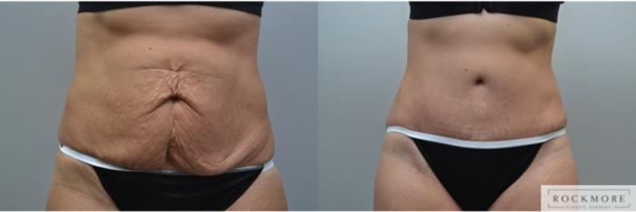 Before & After Tummy Tuck Case 248 View #1 View in Albany & Latham, New York