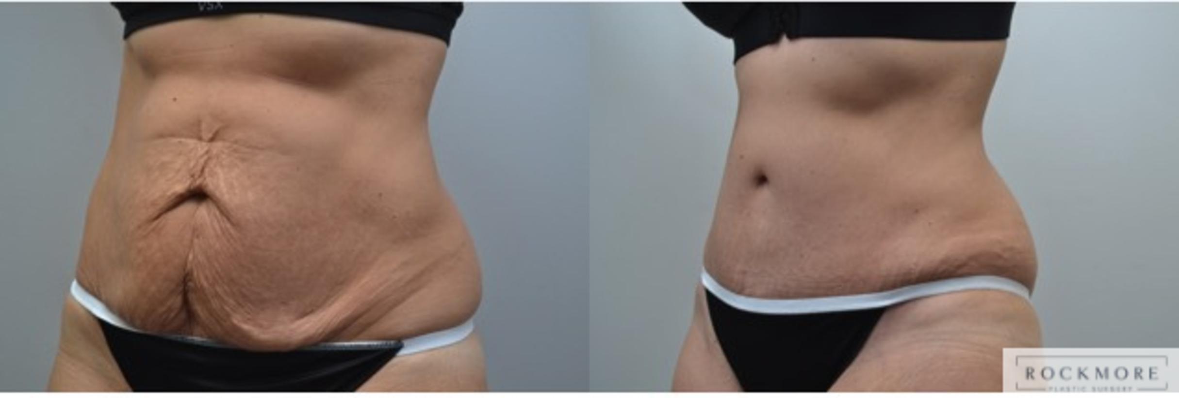 Before & After Tummy Tuck Case 248 View #2 View in Albany & Latham, New York