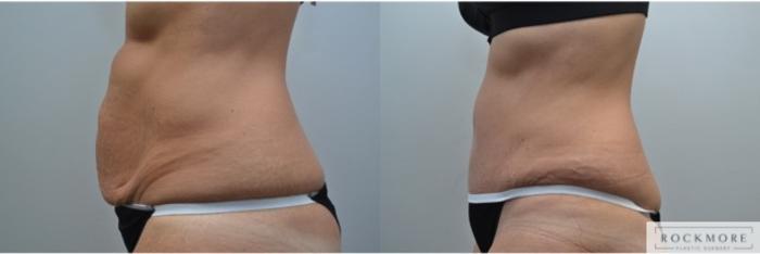 Before & After Tummy Tuck Case 248 View #3 View in Albany & Latham, New York