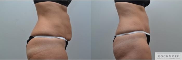 Before & After Tummy Tuck Case 248 View #4 View in Albany & Latham, New York