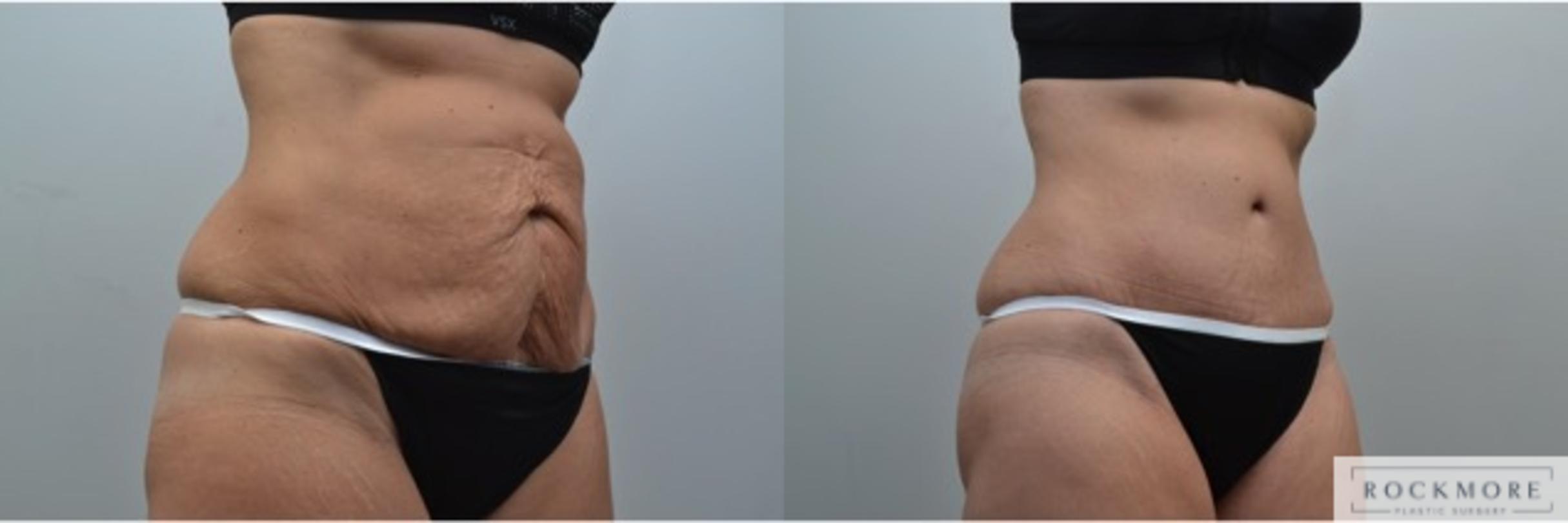 Before & After Tummy Tuck Case 248 View #5 View in Albany & Latham, New York