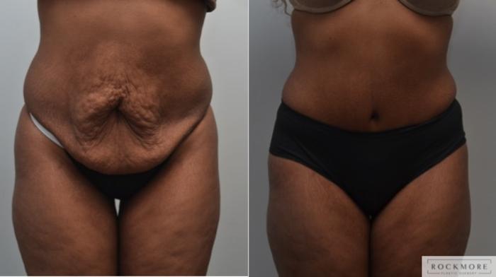 Before & After Tummy Tuck Case 250 View #1 View in Albany & Latham, New York