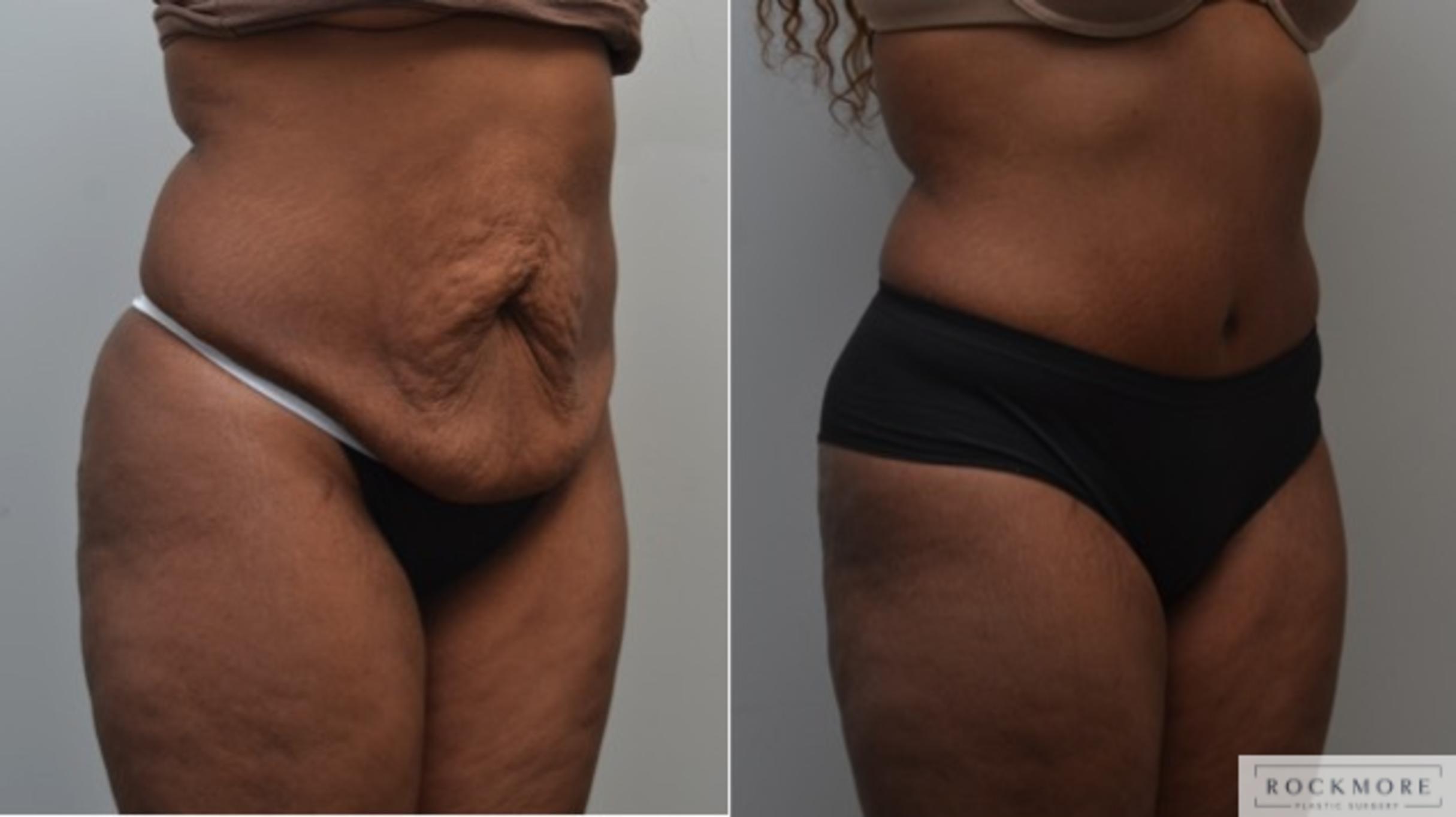 Before & After Tummy Tuck Case 250 View #2 View in Albany & Latham, New York