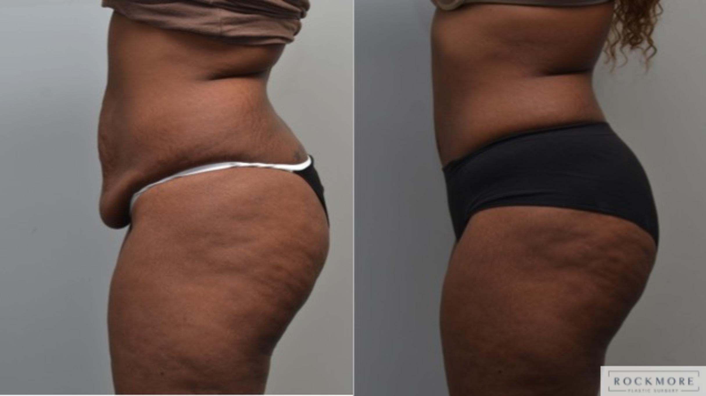 Before & After Tummy Tuck Case 250 View #3 View in Albany & Latham, New York