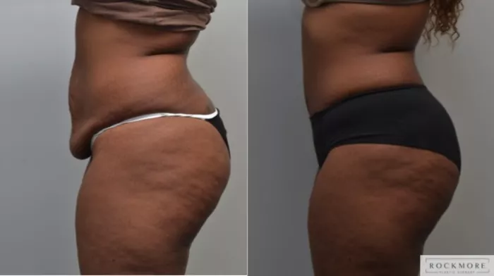 Tummy Tuck Before and After Pictures Case 49, Albany & Latham, New York