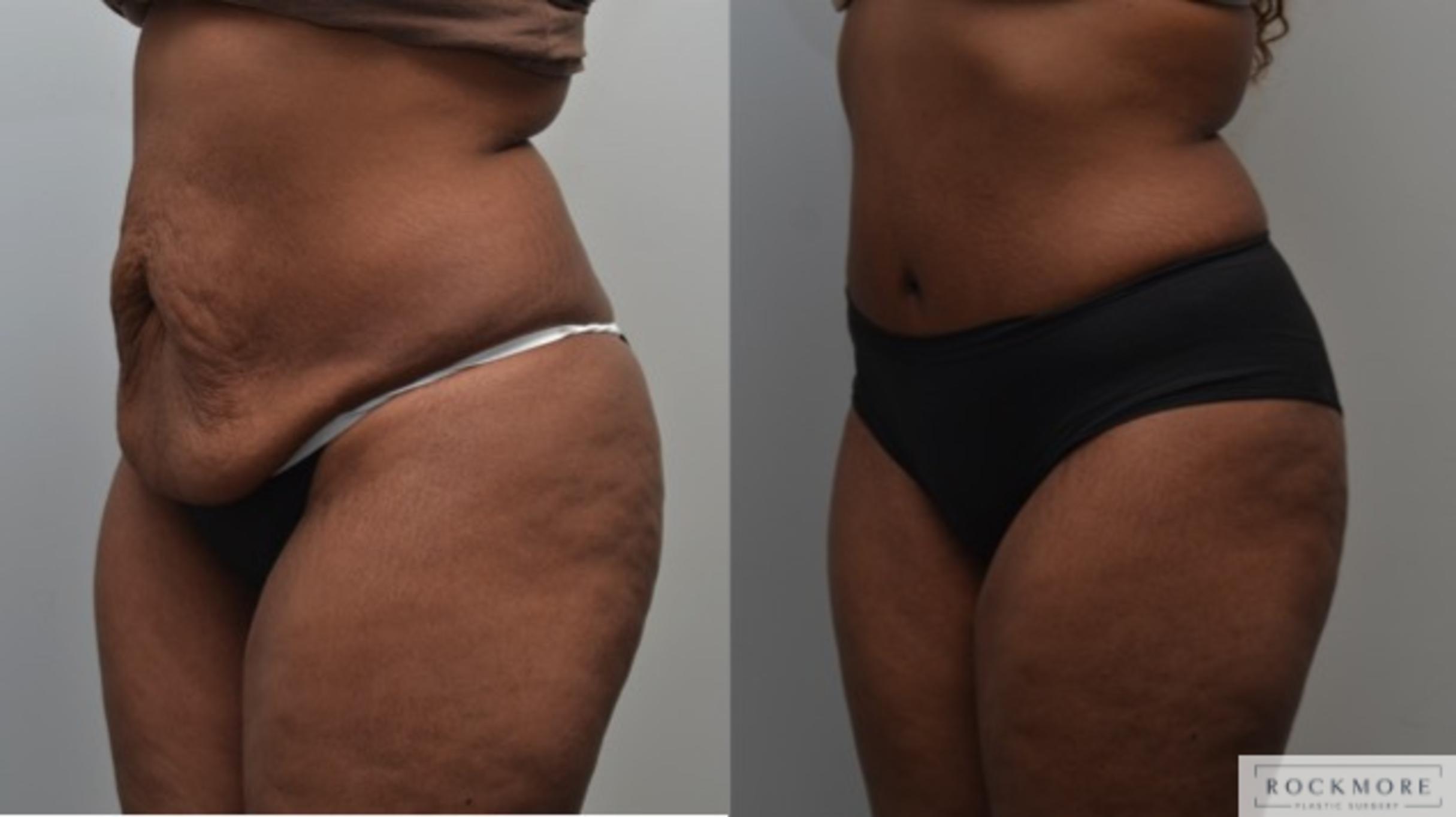 Before & After Tummy Tuck Case 250 View #4 View in Albany & Latham, New York