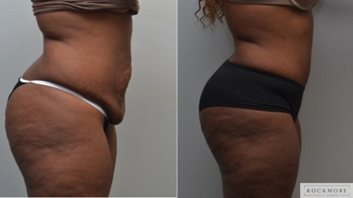 Before & After Tummy Tuck Case 250 View #5 View in Albany & Latham, New York