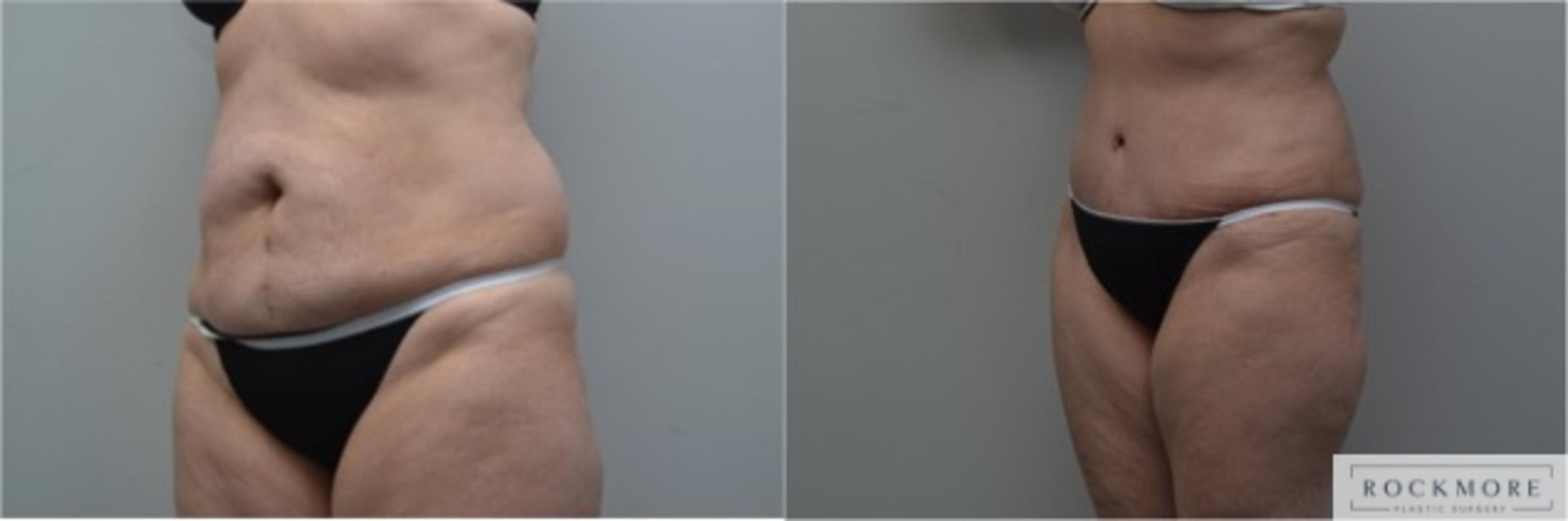 Before & After Tummy Tuck Case 293 View #2 View in Albany & Latham, New York