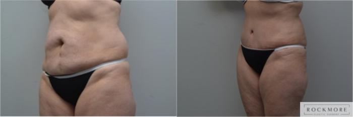 Before & After Tummy Tuck Case 293 View #2 View in Albany & Latham, New York
