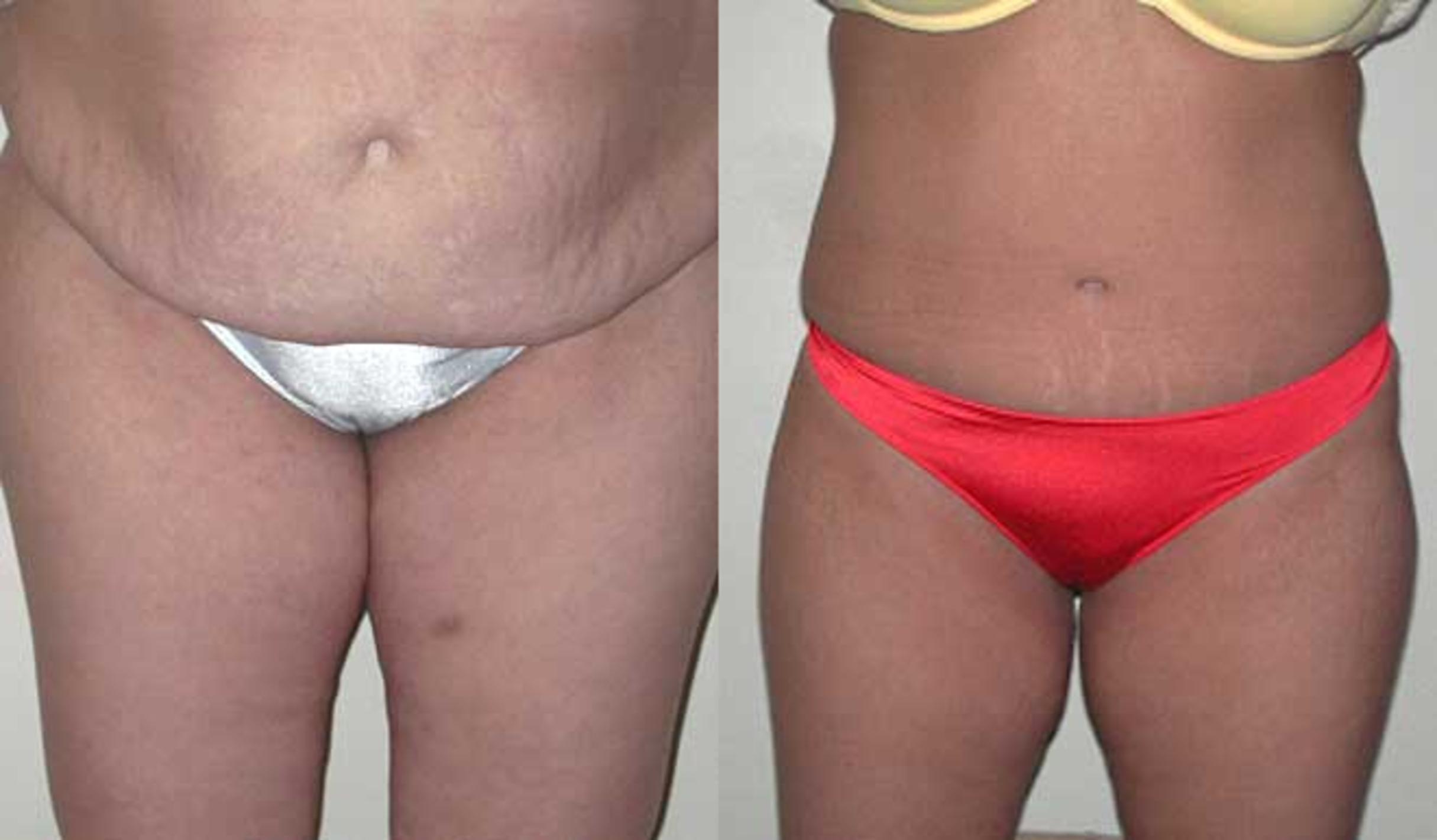 Tummy Tuck Before and After Pictures Case 30