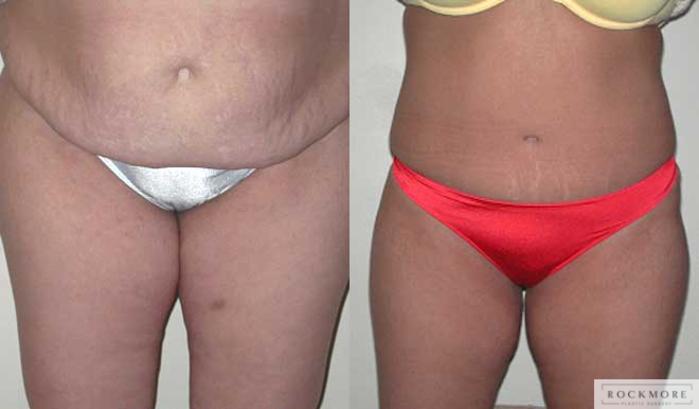 Before & After Tummy Tuck Case 30 View #1 View in Albany & Latham, New York