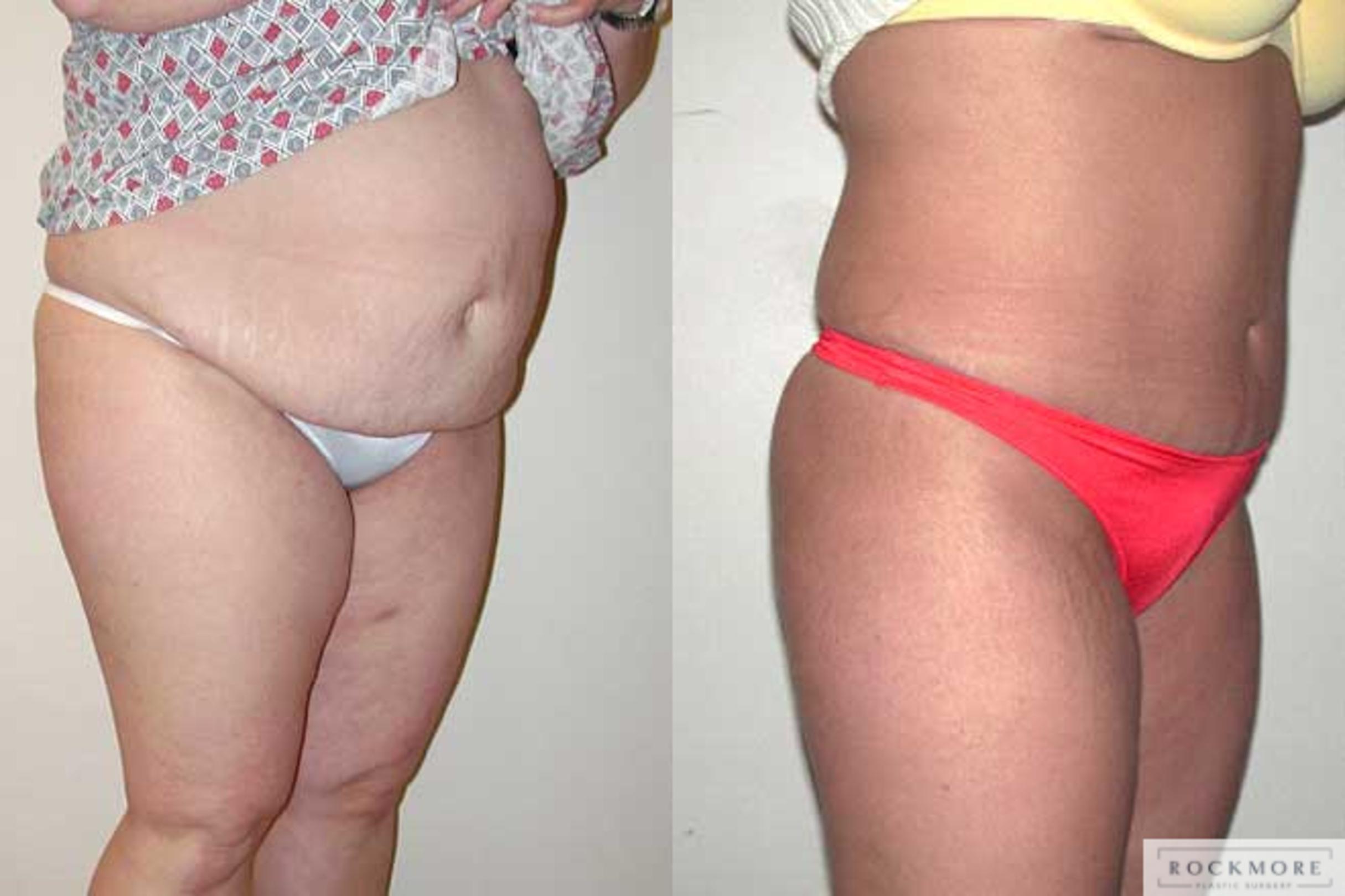 Before & After Tummy Tuck Case 30 View #2 View in Albany & Latham, New York